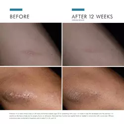 Advanced Scar Control