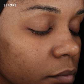 Skinceuticals Before