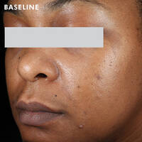 Skinceuticals Before