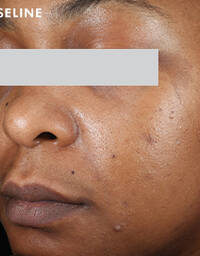 Skinceuticals Before