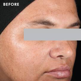 Skinceuticals Before