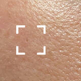 Uneven Skin Texture