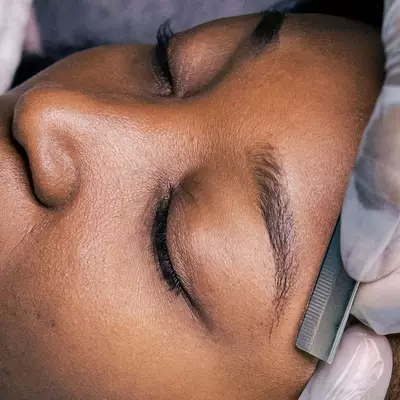 IPL Laser