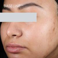 Skinceuticals Before