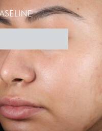 Skinceuticals Before