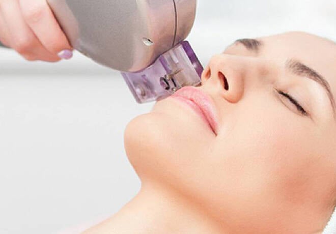 In-Office Laser Treatment