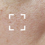 Dehydrated Skin