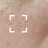 Dehydrated Skin