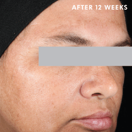 Skinceuticals After