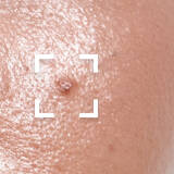 Oily Skin