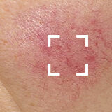 Sensitive Skin