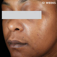 Skinceuticals After