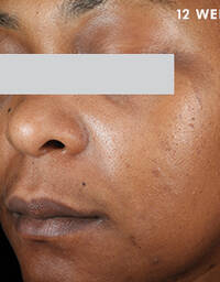 Skinceuticals After