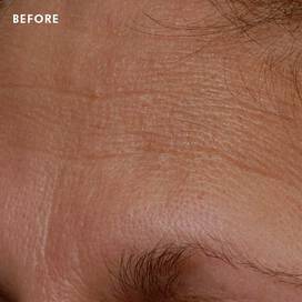 Skinceuticals Before