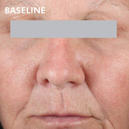 Skinceuticals Before