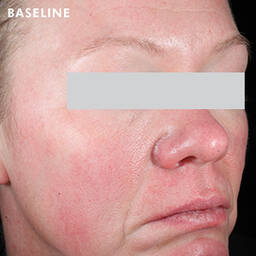 Skinceuticals Before