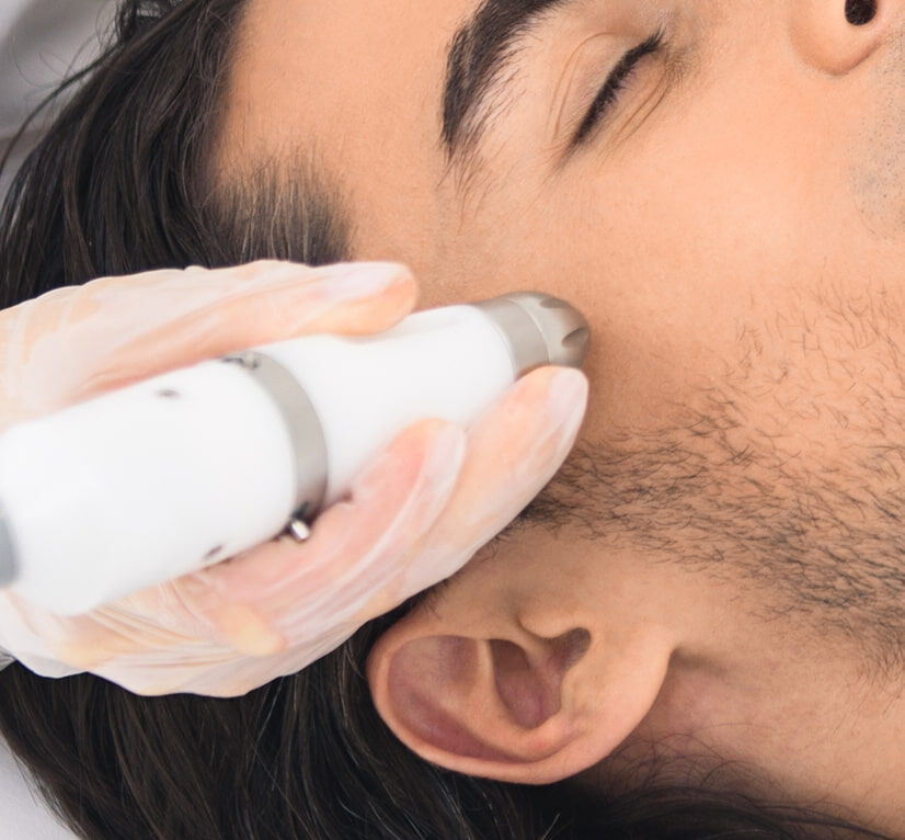 Skin Treatment for Acne