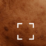 Skin Discoloration