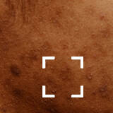 Skin Discoloration