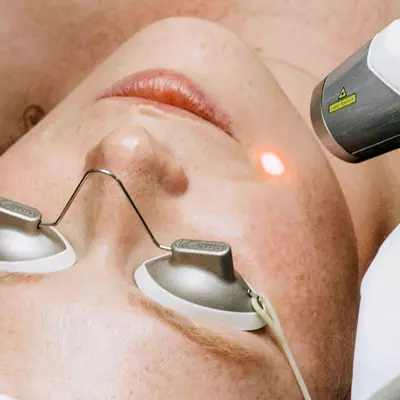 Ablative Laser