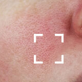 Redness Prone
