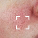 Redness Prone