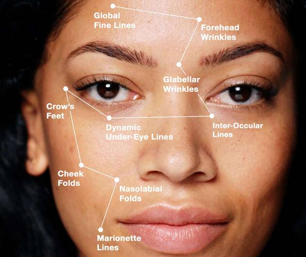Formation of Expression Lines