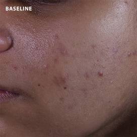 Skinceuticals Before