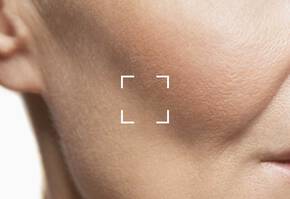 How to Minimize Bruising After Lip Filler Banner