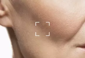 How to Minimize Bruising After Lip Filler Banner