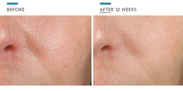 Phloretin CF Before and After